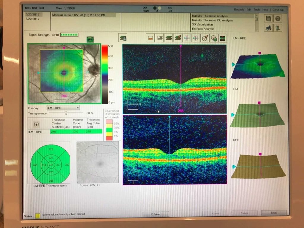 Carl Zeiss Cirrus Hd Oct 5000 Nava Ophthalmic