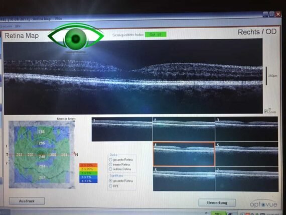 OPTOVUE iVue OCT Retinal Camera