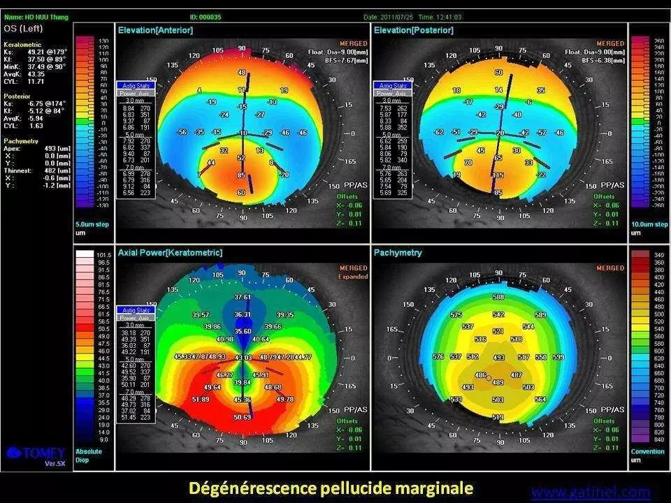 Tomey TMS-4 Corneal Topographer System