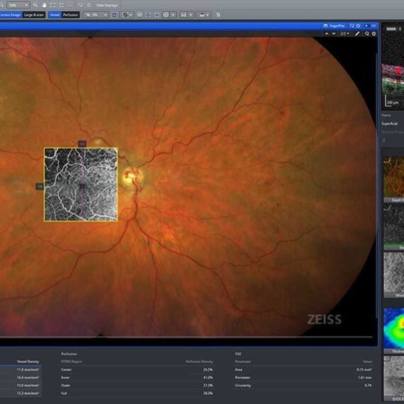 Zeiss Clarus 500 Ultra-widefield (UWF) Imaging System