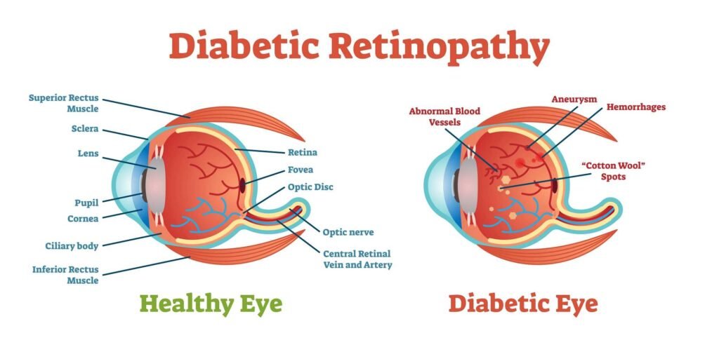 Diabetic Retinopathy