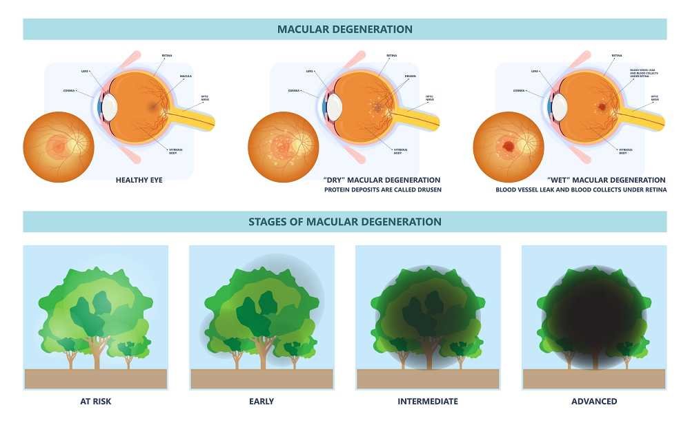 Macular Degeneration