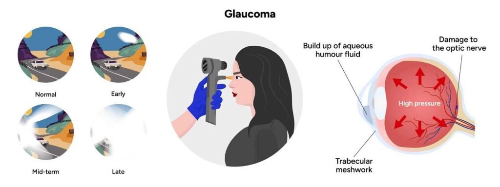 Risk for Glaucoma