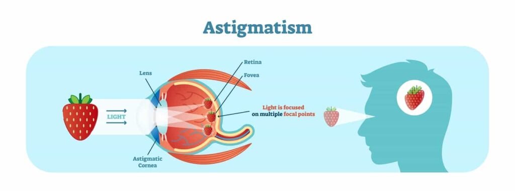 Astigmatism