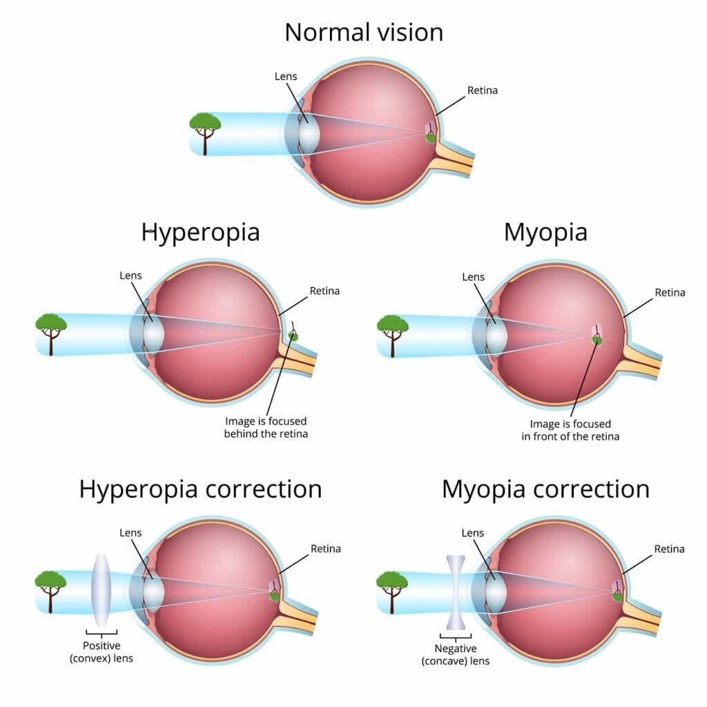Myopia
